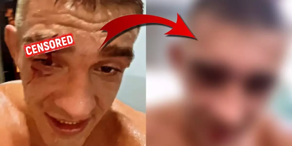 Tak to je sakra změna! Podívejte se, jak po týdnu vypadá Růžičkovo ošklivé zranění