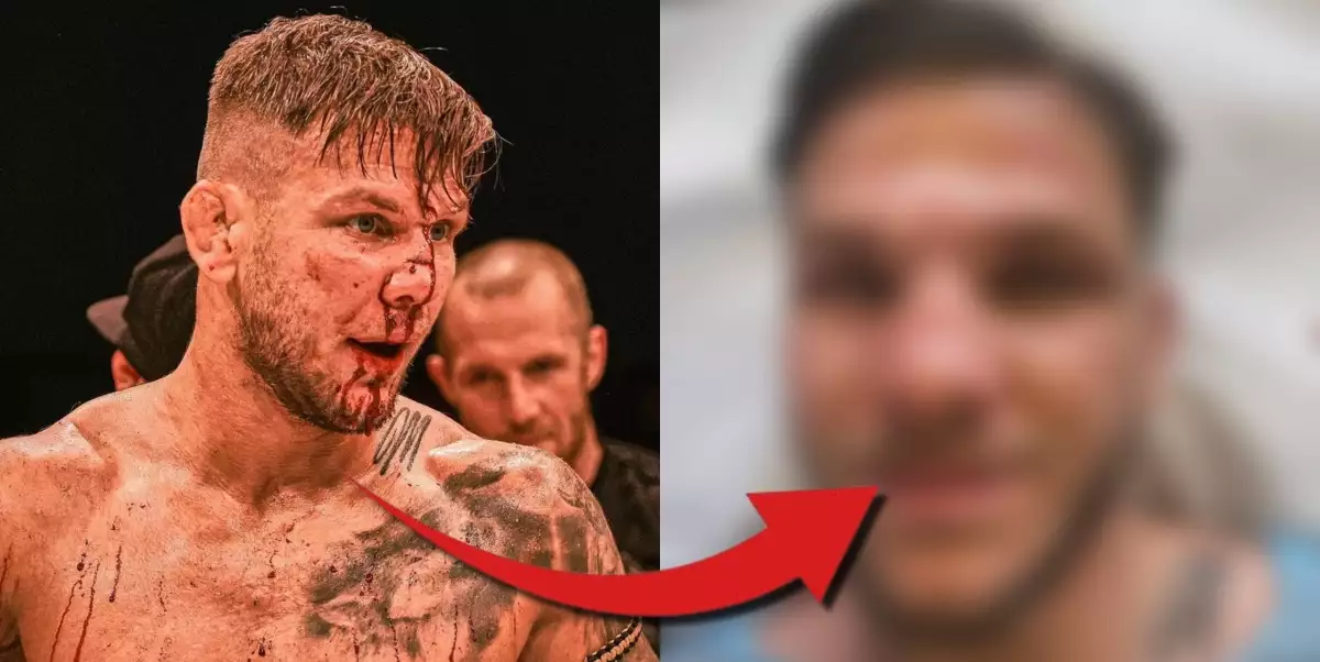 Matouš Kohout se konečně dokopal a vyrazil na plastickou operaci