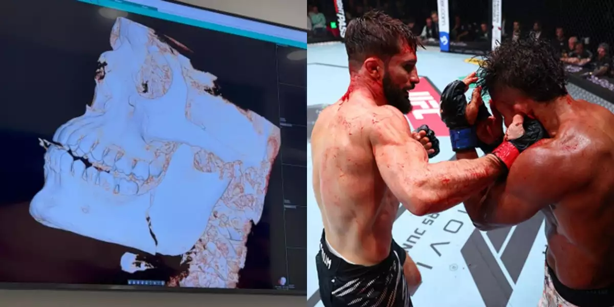 Zápasník se pochlubil snímky zlomené čelisti po památném UFC souboji