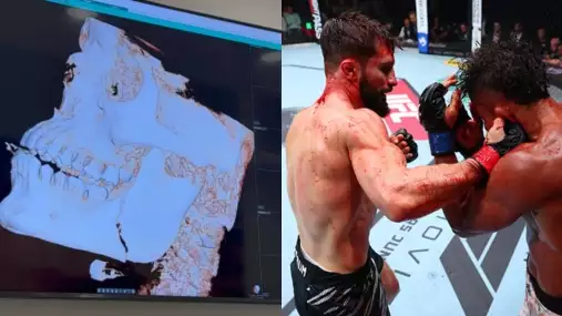 Zápasník se pochlubil snímky zlomené čelisti po památném UFC souboji