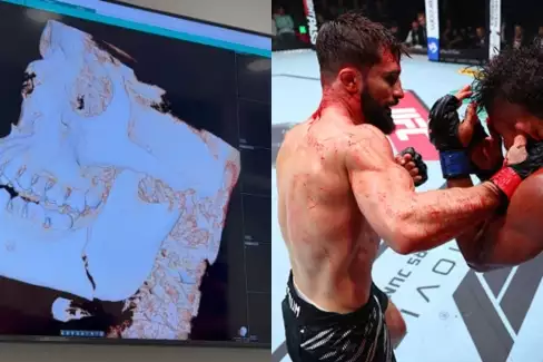 Zápasník se pochlubil snímky zlomené čelisti po památném UFC souboji