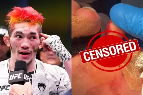 Děsivý obrázek: Šéf UFC Dana White sdílel video nevšedního zranění