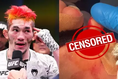 Děsivý obrázek: Šéf UFC Dana White sdílel video nevšedního zranění